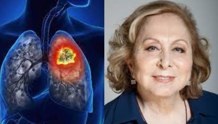 O câncer de pulmão, e seus sinais e fatores de risco da doença de Aracy Balabanian